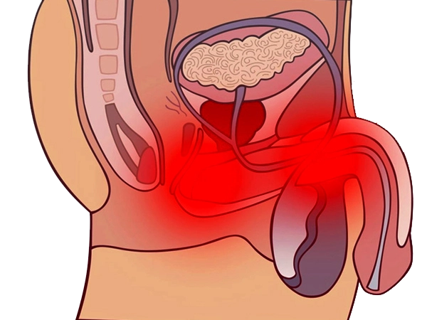 Хронический простатит (воспаление предстательной железы) как причина нарушения семяизвержения